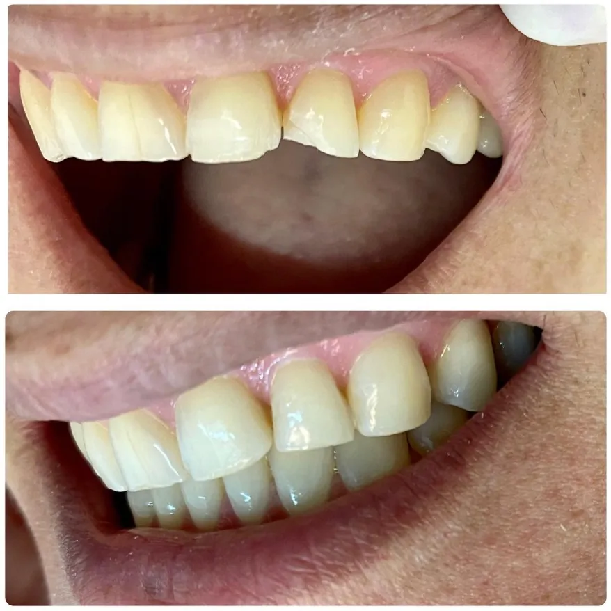 Clareamento dental profissional