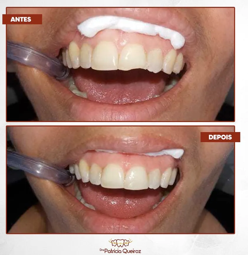 Clareamento com resultados visíveis