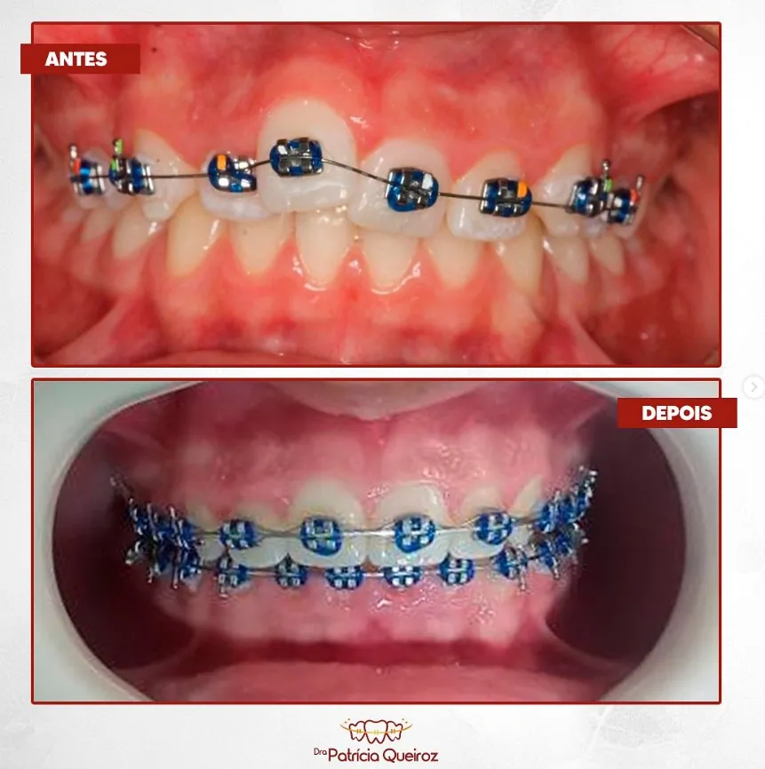 Transformação completa do sorriso