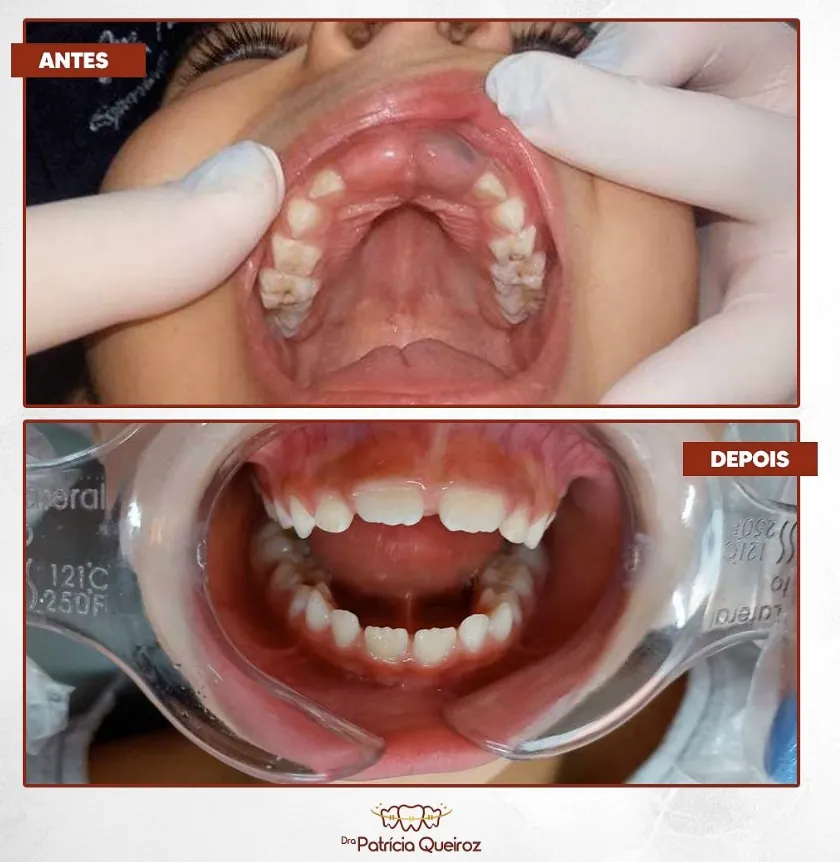 Tratamento odontopediátrico infantil