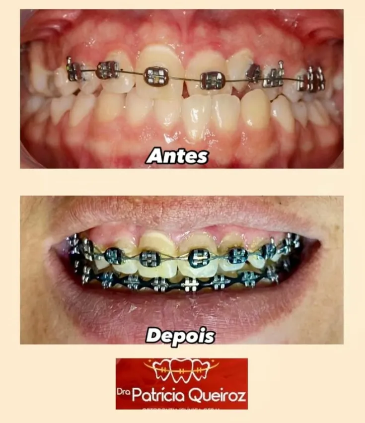 Correção de alinhamento dental com aparelho ortodôntico
