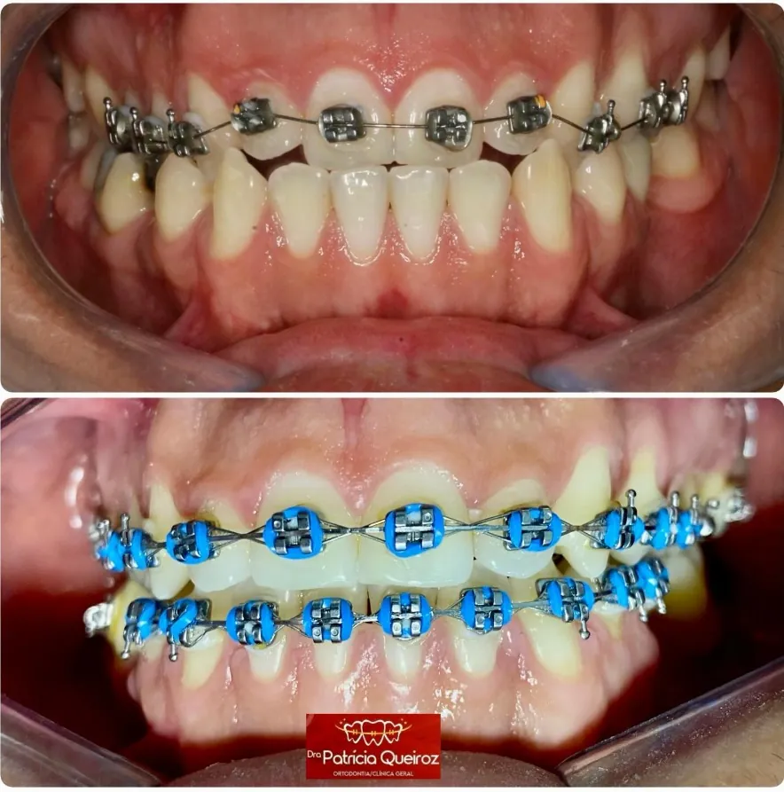 Tratamento ortodôntico para correção de mordida