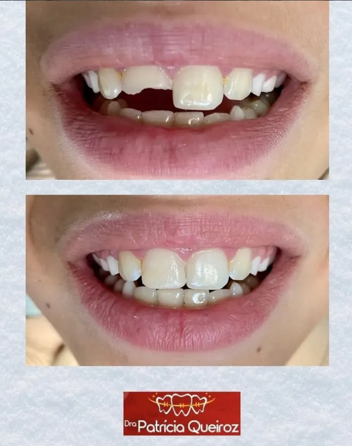 Alinhamento dental com aparelho colorido