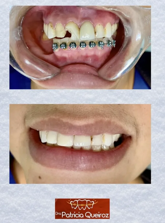 Correção ortodôntica com prótese