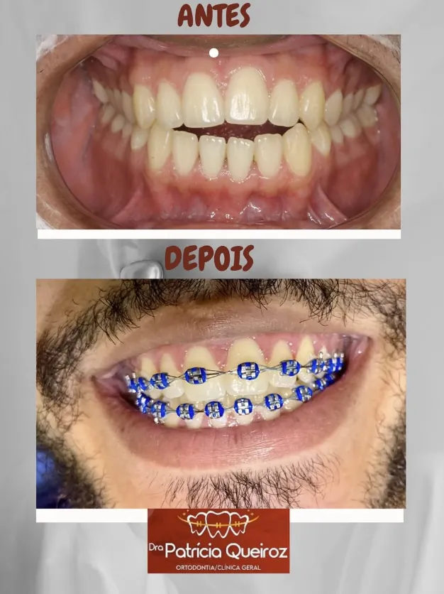 Tratamento com aparelho azul