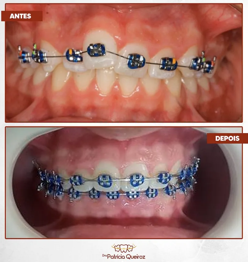 Ajuste de aparelho ortodôntico