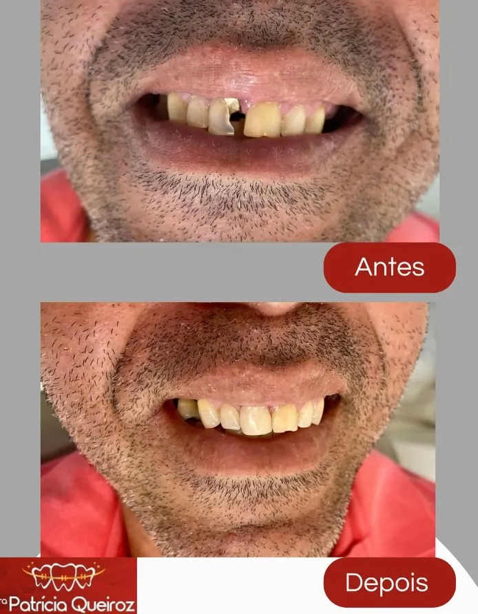 Restauração de dente danificado
