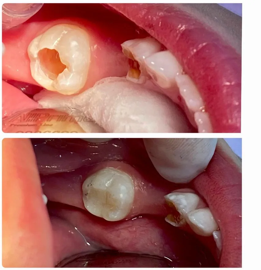 Tratamento restaurador completo