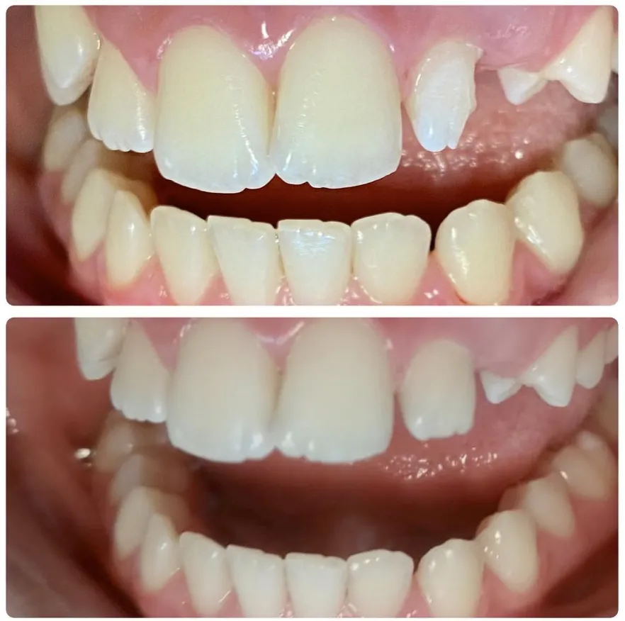 Restauração de dente lascado